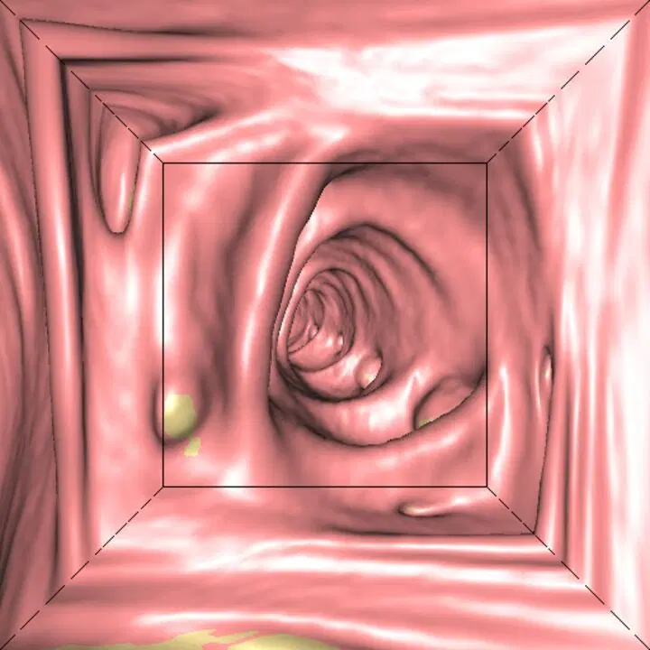 Virtuális 3D vastagbél leképezés